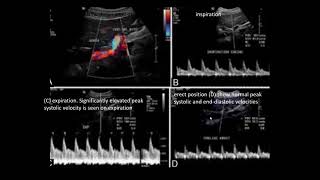 Triplex Ultrasound MEDIAN ARCUATE LIGAMENT SYNDROME Dr Ahmed esawy [upl. by Lauber483]