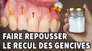 Incroyable Il S’agit D’un Remède À La Maison Pour La Récession Gingivale [upl. by Anatnahs]