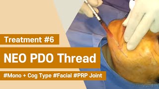 NeoGenesis Thread Series PDO Cog  Mono Type Facial Joint Procedure with PRP [upl. by Conchita780]