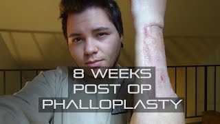 FTM  8 Weeks Phalloplasty Post Op [upl. by Lori]