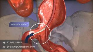 Aortic Aneurysm Repair by Endologix device [upl. by Ainocal]