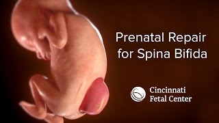 Spina Bifida Medical Animation  Cincinnati Fetal Center [upl. by Clintock]