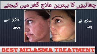 Treat Melasma At Home  Best Melasma Treatment  Dr shahzad Hashmi Lecture 107 [upl. by Cara]