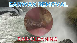 Ear Wax Removal 185 Earwax is very dry and very hard causing itching and pain  Ear Cleaning ASMR [upl. by Aitret31]