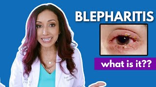 What Is Blepharitis Eye Doctor Explains [upl. by Anytsyrk]