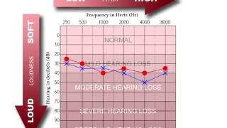 How to Read an Audiogram [upl. by Ianahs]