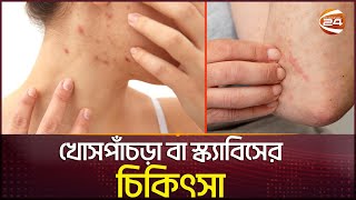 চুলকানি বা স্ক্যাবিস থেকে সুরক্ষার উপায়  Skin Care  Scabies  Channel 24 [upl. by Agem]