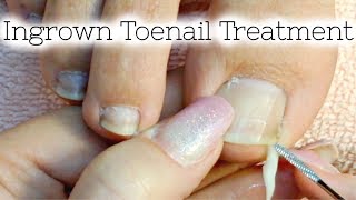 Pedicure Tutorial Ingrown Toenail Treatment At Home How to Recut Nail Groove to Eliminate Pain [upl. by Okramed]