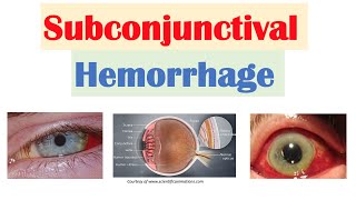 Subconjunctival Hemorrhage Blood in Eye  Causes Signs amp Symptoms Diagnosis Treatment [upl. by Acnairb525]