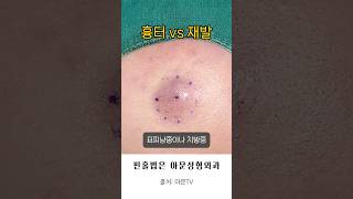 흉터 vs 재발 피지 멍울 압출 핀홀법 피지낭종 표피낭종 지방종 수술 아문성형외과 병원 epidermal cyst lipoma surgery seoul korea아문TV [upl. by Moneta]