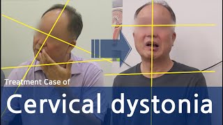 Dystonia  Cervical Dystonia  Spasmodic Torticollis  사경증 치료사례  근긴장이상증 [upl. by Nol]