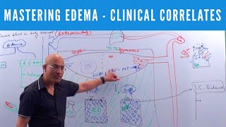 Mastering Edema  Types Causes Symptoms amp Treatment 👨‍⚕️ [upl. by Wiskind741]