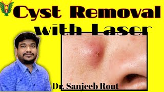 Cyst Removal With Laser  Dr Sanjeeb Rout  Balaji skin and hair clinic  Talcher 8895430161 [upl. by Spillar]