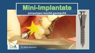 OeA I Einsetzen von MINIIMPLANTATEN  ORTHODONTIC MINISCREW INSERTION [upl. by Oderf79]