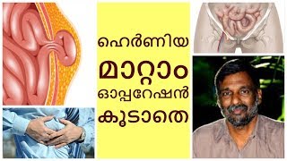 Treatment for Hernia without operation  Mohanan Vaidyar [upl. by Aramot]