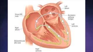 Supraventricular Tachycardia [upl. by Ilsa]