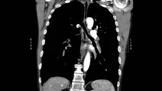 Acute massive pulmonary embolism with right heart strain CT Coronal JETem 2017 [upl. by Ised]