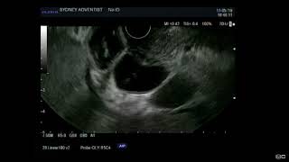 EUS Guided Biliary Drainage Choledochoduodenostomy with Hot Axios [upl. by Gerhard451]