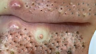 Big Cystic Acne Blackheads Extraction Blackheads amp Milia Whiteheads Removal Pimple Popping  6549 [upl. by Naujed]