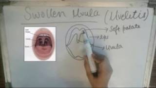 Swollen uvula  Uvulitis Introduction and causes of Swollen Uvula [upl. by Theresita127]