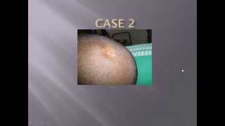 Case Study Aplasia Cutis Congenita Cutis Aplasia [upl. by Fiora]