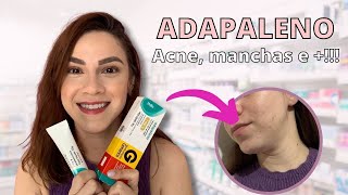 ADAPALENO ACABA COM A ACNE CLAREIA MANCHAS E MUITO MAIS [upl. by Saberio]