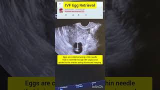 Is IVF Egg Retrieval painful  infertilitytreatment ivf drrakshitamalik ivfprocess ivfjourney [upl. by Viking617]