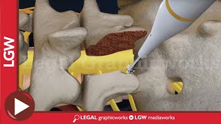 L5S1 Lumbar Discectomy and Fusion Surgery 3D animation [upl. by Leidba]