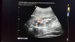 Malrotated Kidney Ultrasound [upl. by Illah915]