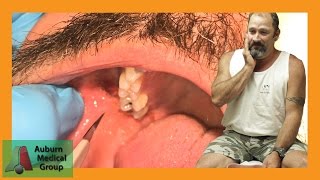 PAINFUL DENTAL ABSCESS DRAINED  Auburn Medical Group [upl. by Gnouhp926]