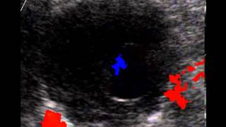 AORTIC ANEURYSM WITH MURAL THROMBUS [upl. by Moreville]