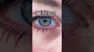 IRIS Heterochromia coloured EYE 👁️ 🧡 eyes rare aesthetic [upl. by Etteniuqna45]