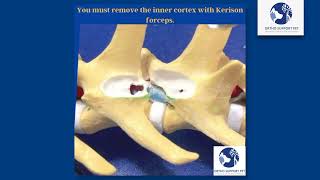 Hemilaminectomy in dogs [upl. by Zeuqram]