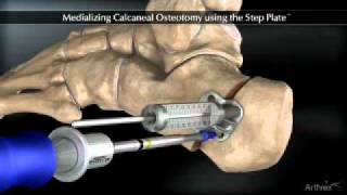 Medializing Calcaneal Osteotomy [upl. by Junko420]