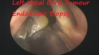 Laryngology  Left Vocal Cord Tumour Endoscopic Biopsy [upl. by Annaeg]