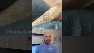 Ingrown hair frenzy ingrownhair dermreacts doctorreacts [upl. by Lichter]