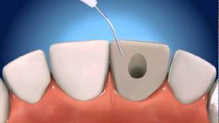 Root Canal Therapy RCT  The Gentle Dentist [upl. by Aicitel]