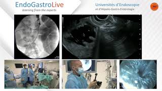 Gastroentéroanastomose endoscopique [upl. by Stanfill]