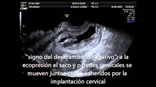 Ectopico cervical [upl. by Rehsa]