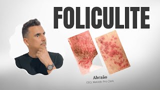 FOLICULITE O que é Quais pomadas indicadas Tratamento Medicamento [upl. by Tse359]