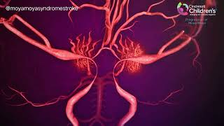 Prograsion of moya moya syndrome oleh cincinati children hospital [upl. by Cottrell825]