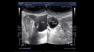 Ultrasound Video showing agerelated Calcification and Hemangioma in the Uterus [upl. by Dej]