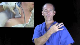 Supraclavicular nerve block ultrasound guided [upl. by Ardelis]