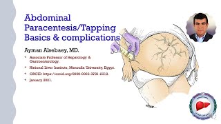 Abdominal ParacentesisT apping Basics amp complications [upl. by Parrnell]