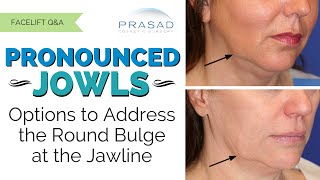 The Different Causes of Jowls Along the Jawline and their Customized Treatments [upl. by Neila5]