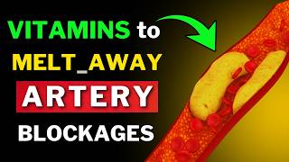 Remove Artery Plaque Naturally 6 Powerful Vitamins [upl. by Marva]