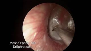 ENDOCSOPIC MUCOID OTITIS MEDIA DRAINAGE [upl. by Cindra992]