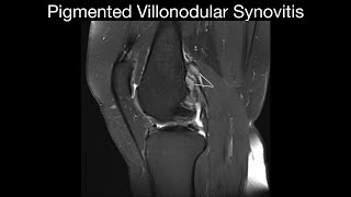 Pigmented Villonodular Synovitis 1 [upl. by Ihculo24]