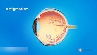 Astigmatisme  Flou visuel et déformation ovale de la cornée ou de lœil [upl. by Good]