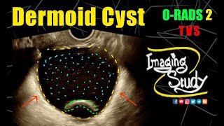 Adnexal Dermoid Cyst  Mature Cystic Teratoma  ORADS 2  Ultrasound  TVS  Case 316 [upl. by Pegg]